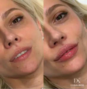 Dr Dalibor Lips — pre i posle — rezultat 2